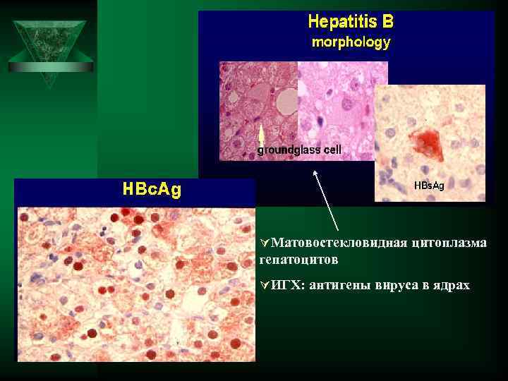 ÚМатовостекловидная цитоплазма гепатоцитов ÚИГХ: антигены вируса в ядрах 