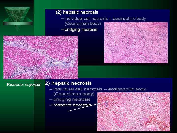 Коллапс стромы 