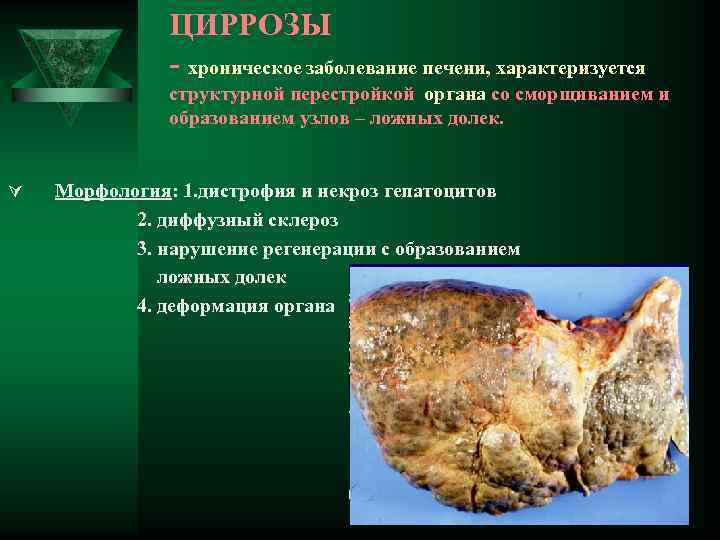 ЦИРРОЗЫ - хроническое заболевание печени, характеризуется структурной перестройкой органа со сморщиванием и образованием узлов