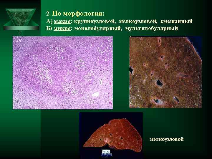 2. По морфологии: А) макро: крупноузловой, мелкоузловой, смешанный Б) микро: монолобулярный, мультилобулярный мелкоузловой 