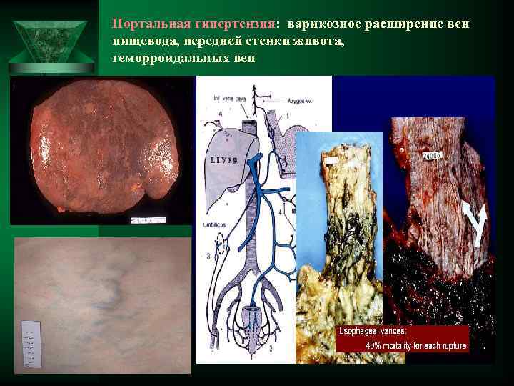 Портальная гипертензия: варикозное расширение вен пищевода, передней стенки живота, геморроидальных вен 