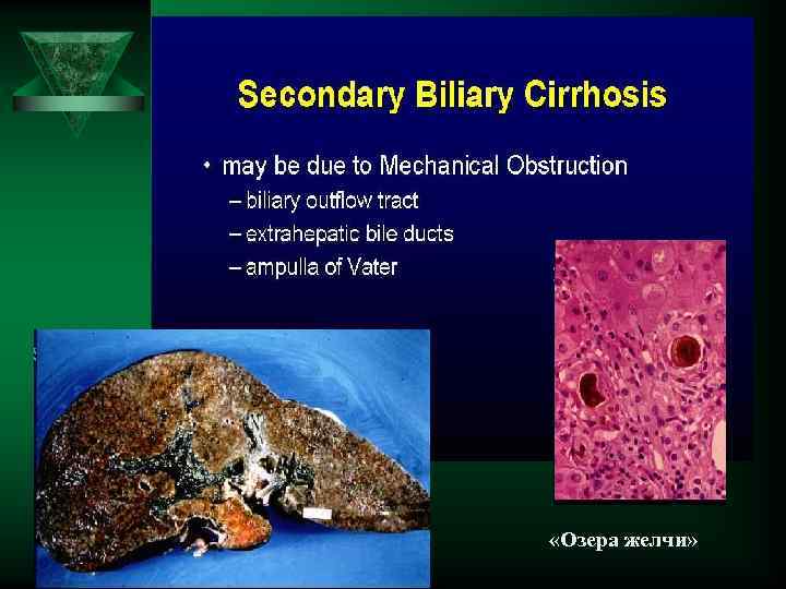  «Озера желчи» 