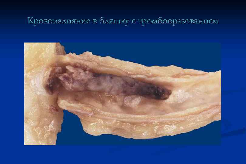 Кровоизлияние в бляшку с тромбооразованием 