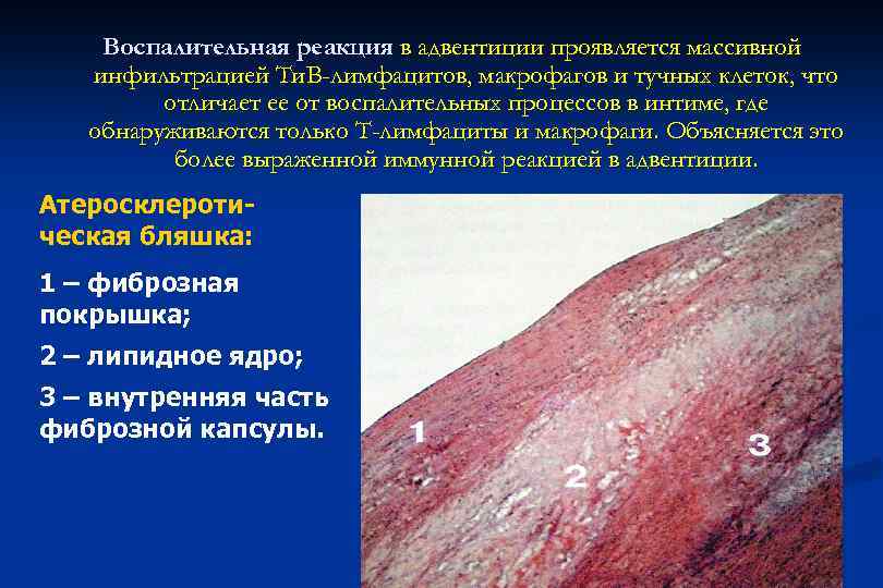 Воспалительная реакция в адвентиции проявляется массивной инфильтрацией Ти. B-лимфацитов, макрофагов и тучных клеток, что