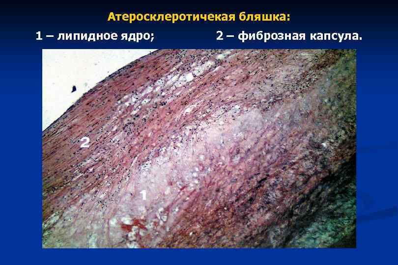 Атеросклеротичекая бляшка: 1 – липидное ядро; 2 – фиброзная капсула. 