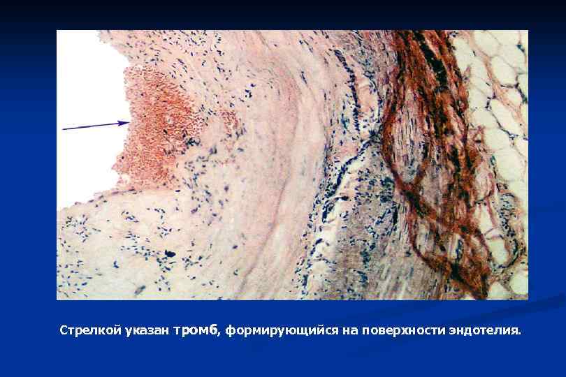 Стрелкой указан тромб, формирующийся на поверхности эндотелия. 