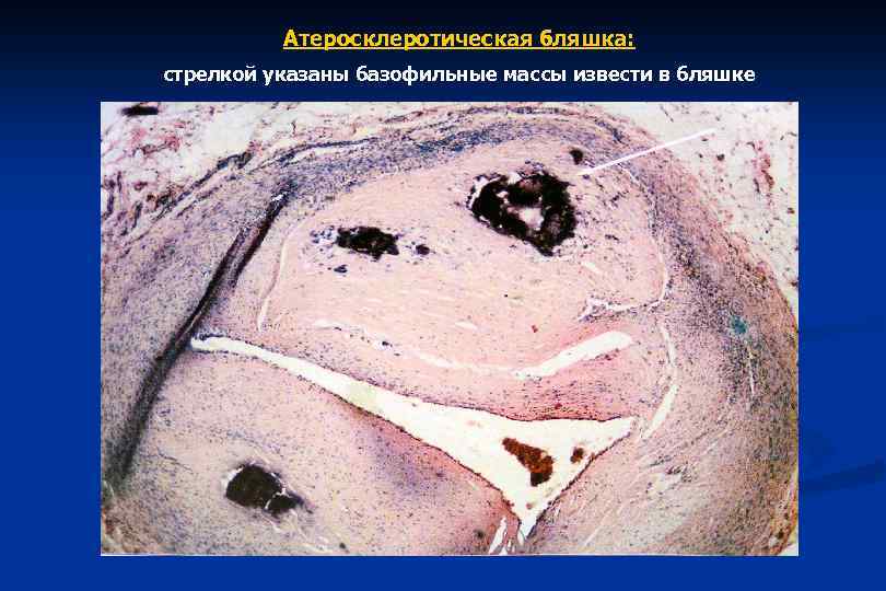 Атеросклеротическая бляшка: стрелкой указаны базофильные массы извести в бляшке 