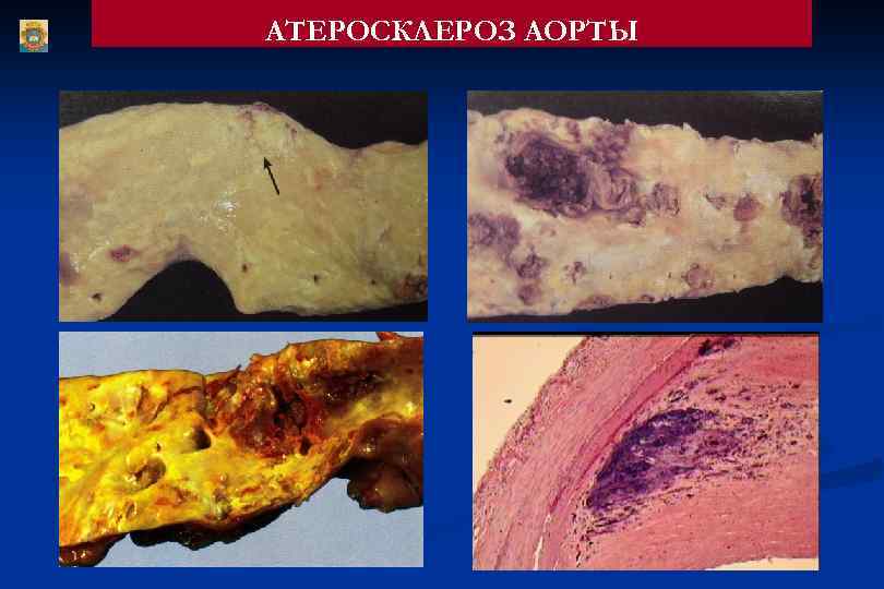 АТЕРОСКЛЕРОЗ АОРТЫ 