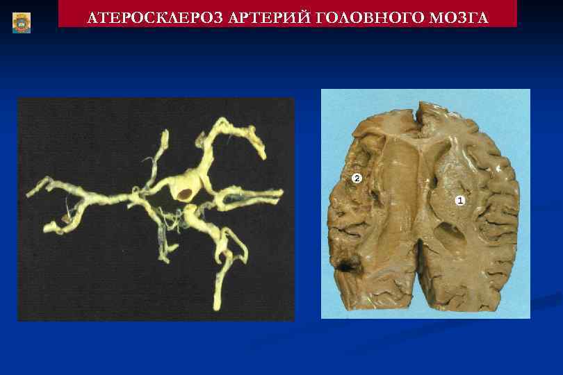 АТЕРОСКЛЕРОЗ АРТЕРИЙ ГОЛОВНОГО МОЗГА 