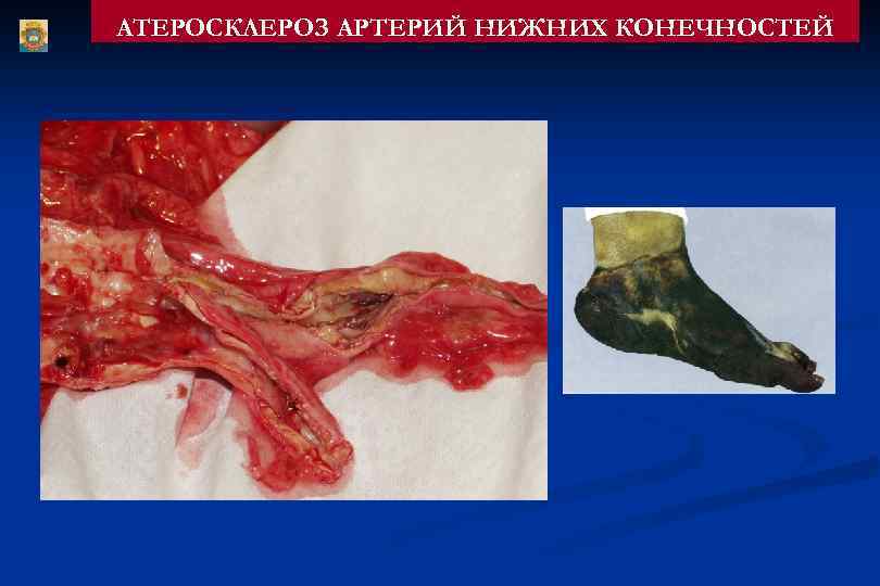 АТЕРОСКЛЕРОЗ АРТЕРИЙ НИЖНИХ КОНЕЧНОСТЕЙ 