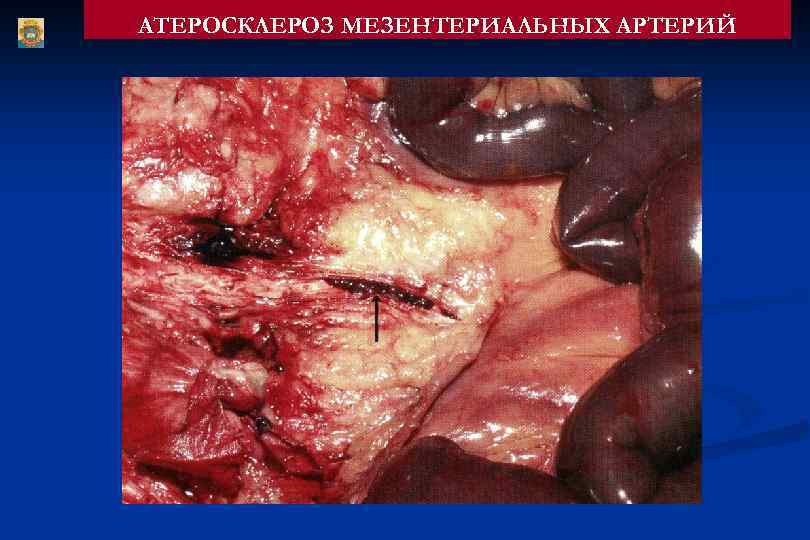 АТЕРОСКЛЕРОЗ МЕЗЕНТЕРИАЛЬНЫХ АРТЕРИЙ 