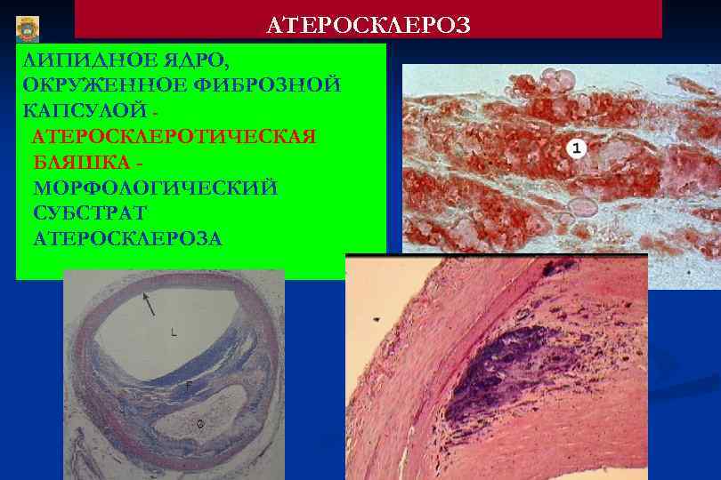 АТЕРОСКЛЕРОЗ ЛИПИДНОЕ ЯДРО, ОКРУЖЕННОЕ ФИБРОЗНОЙ КАПСУЛОЙ АТЕРОСКЛЕРОТИЧЕСКАЯ БЛЯШКА МОРФОЛОГИЧЕСКИЙ СУБСТРАТ АТЕРОСКЛЕРОЗА 