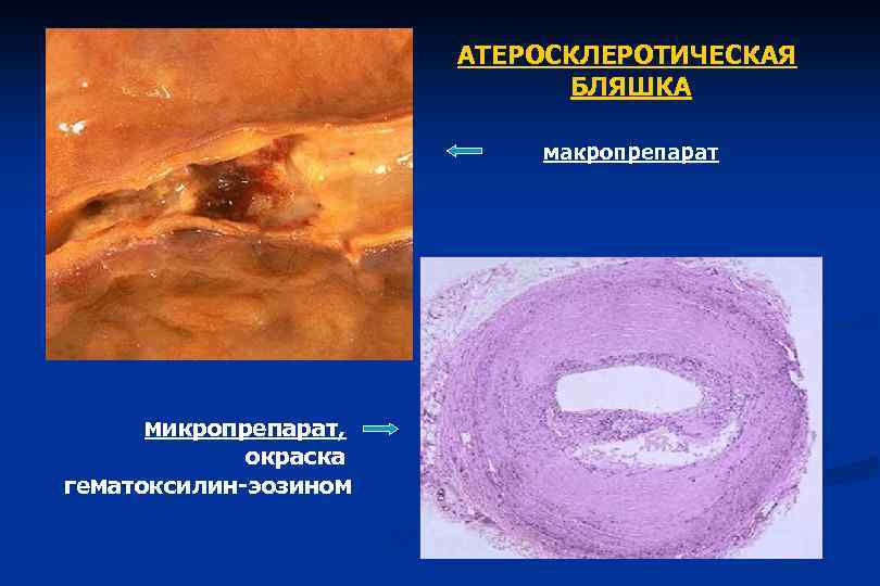 АТЕРОСКЛЕРОТИЧЕСКАЯ БЛЯШКА макропрепарат микропрепарат, окраска гематоксилин-эозином 
