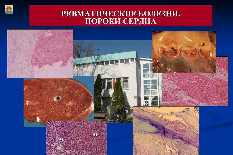 РЕВМАТИЧЕСКИЕ БОЛЕЗНИ. ПОРОКИ СЕРДЦА 