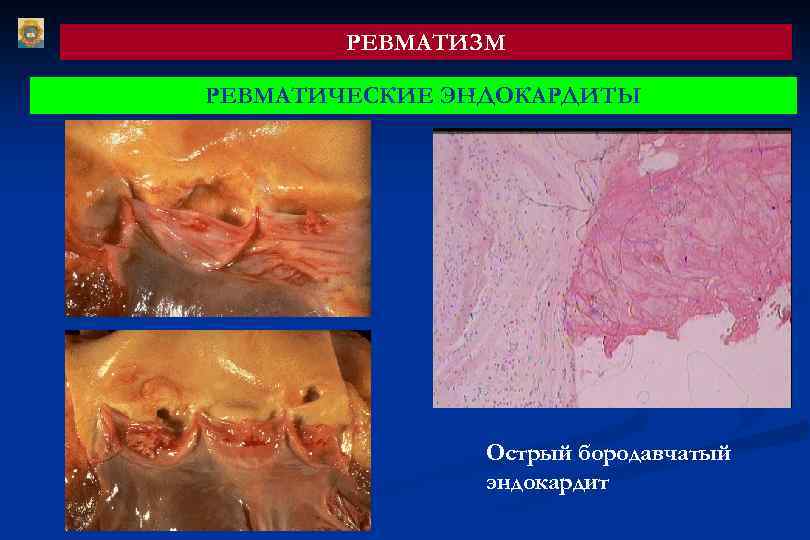 РЕВМАТИЗМ РЕВМАТИЧЕСКИЕ ЭНДОКАРДИТЫ Острый бородавчатый эндокардит 