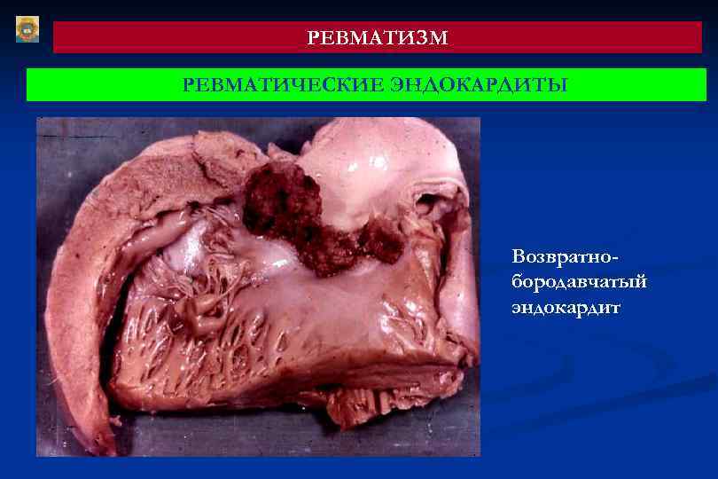 РЕВМАТИЗМ РЕВМАТИЧЕСКИЕ ЭНДОКАРДИТЫ Возвратнобородавчатый эндокардит 