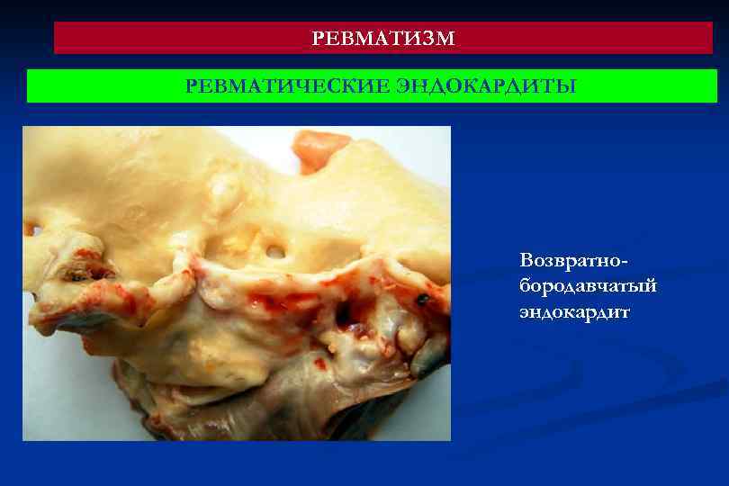 РЕВМАТИЗМ РЕВМАТИЧЕСКИЕ ЭНДОКАРДИТЫ Возвратнобородавчатый эндокардит 