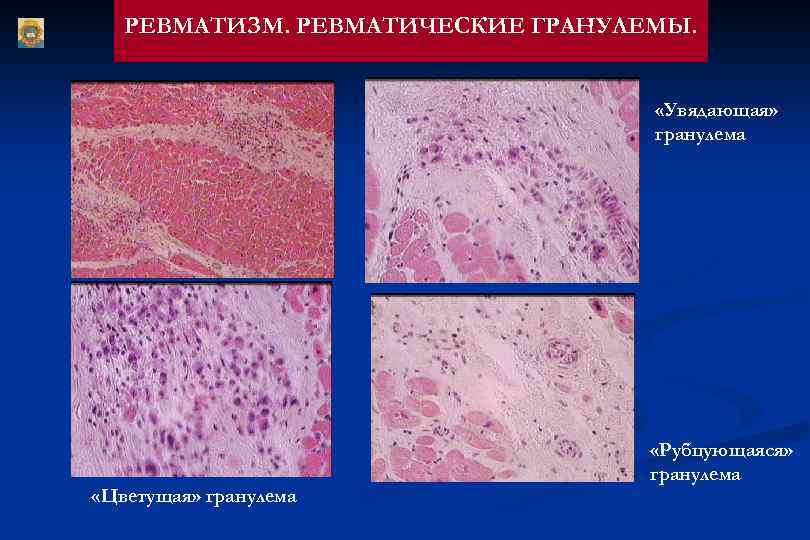 РЕВМАТИЗМ. РЕВМАТИЧЕСКИЕ ГРАНУЛЕМЫ. «Увядающая» гранулема «Цветущая» гранулема «Рубцующаяся» гранулема 