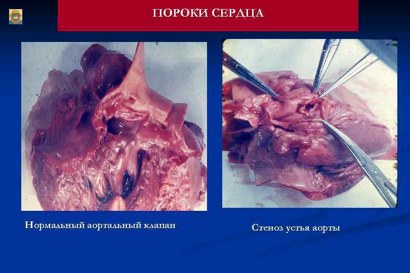 ПОРОКИ СЕРДЦА Нормальный аортальный клапан Стеноз устья аорты 