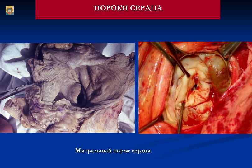 ПОРОКИ СЕРДЦА Митральный порок сердца 