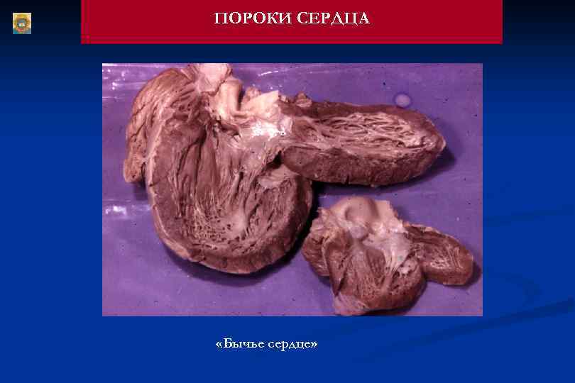 ПОРОКИ СЕРДЦА «Бычье сердце» 