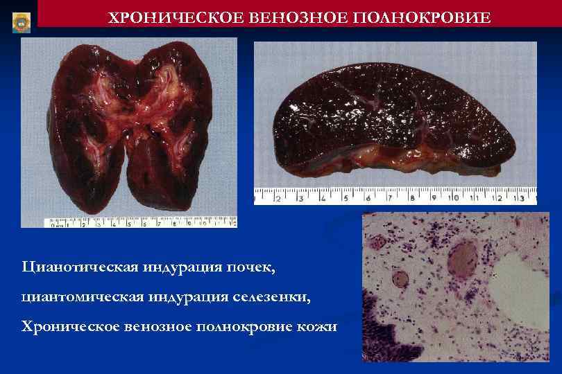 ХРОНИЧЕСКОЕ ВЕНОЗНОЕ ПОЛНОКРОВИЕ Цианотическая индурация почек, циантомическая индурация селезенки, Хроническое венозное полнокровие кожи 