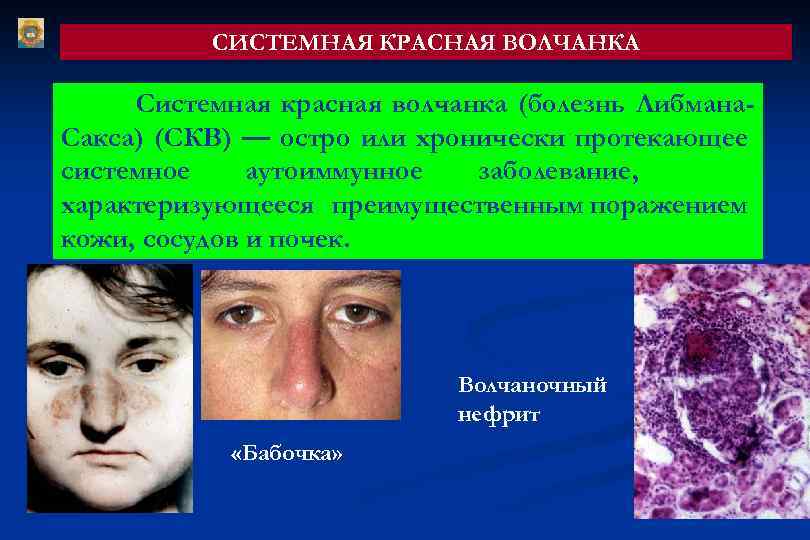 СИСТЕМНАЯ КРАСНАЯ ВОЛЧАНКА Системная красная волчанка (болезнь Либмана. Сакса) (СКВ) — остро или хронически