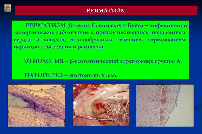 РЕВМАТИЗМ (болезнь Сокольского-Буйо) – инфекционно -аллергическое заболевание с преимущественным поражением сердца и сосудов, волнообразным