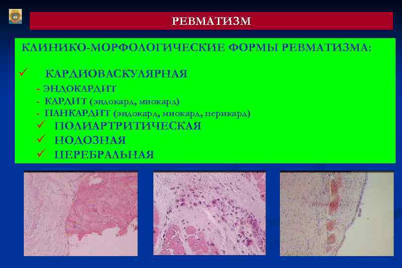 РЕВМАТИЗМ КЛИНИКО-МОРФОЛОГИЧЕСКИЕ ФОРМЫ РЕВМАТИЗМА: ü КАРДИОВАСКУЛЯРНАЯ - ЭНДОКАРДИТ - КАРДИТ (эндокард, миокард) - ПАНКАРДИТ