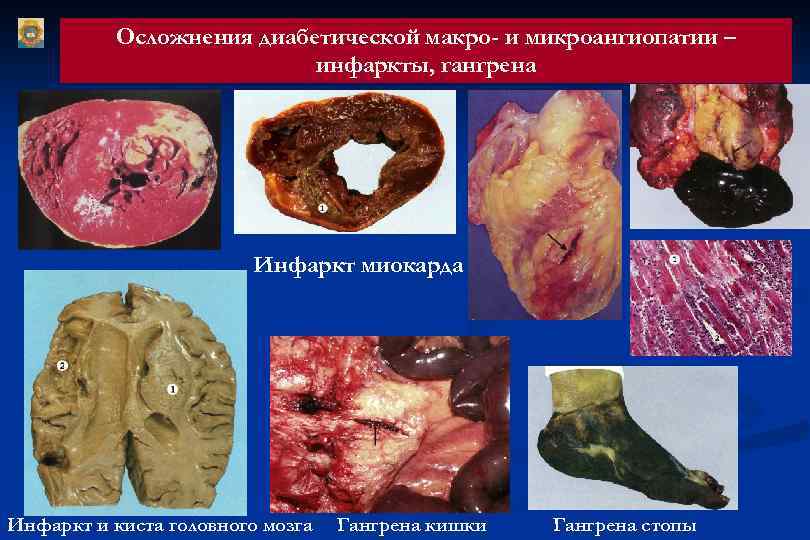 Осложнения диабетической макро- и микроангиопатии – инфаркты, гангрена Инфаркт миокарда Инфаркт и киста головного