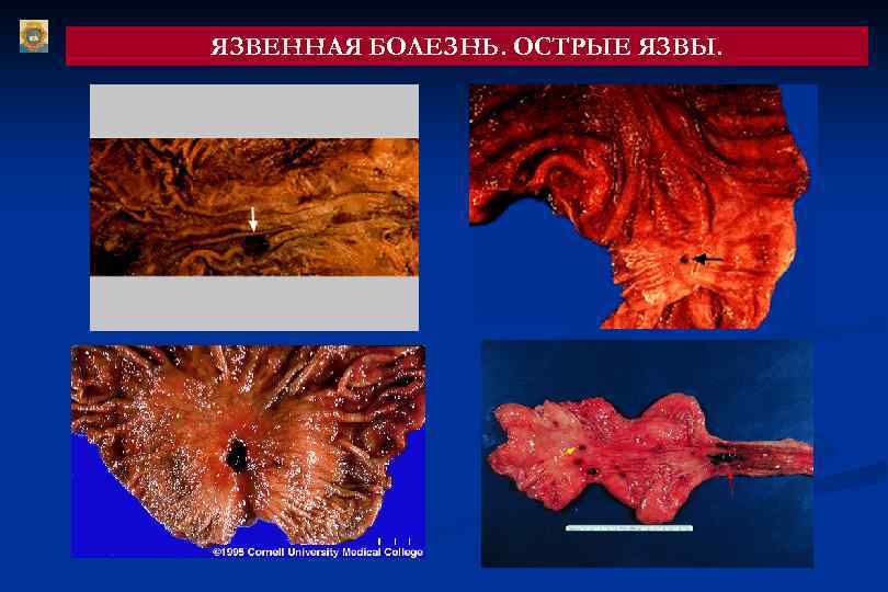 ЯЗВЕННАЯ БОЛЕЗНЬ. ОСТРЫЕ ЯЗВЫ. 