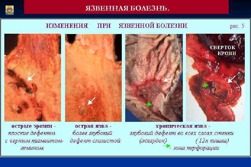 ЯЗВЕННАЯ БОЛЕЗНЬ. 