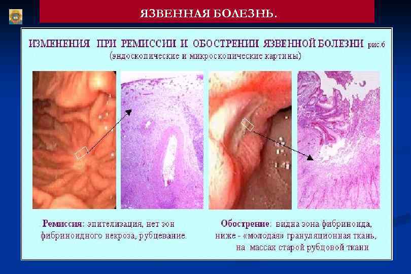 ЯЗВЕННАЯ БОЛЕЗНЬ. 