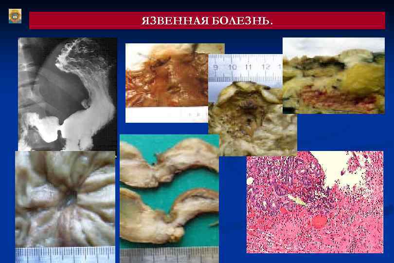 ЯЗВЕННАЯ БОЛЕЗНЬ. 