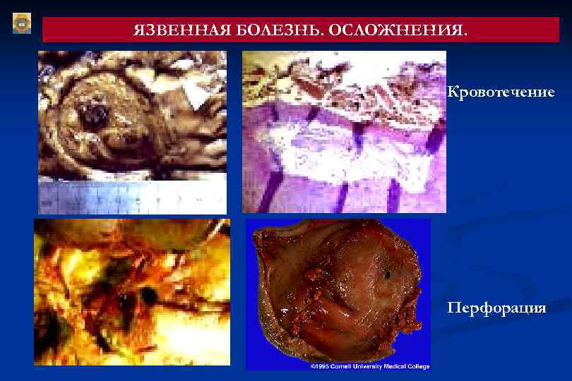 ЯЗВЕННАЯ БОЛЕЗНЬ. ОСЛОЖНЕНИЯ. Кровотечение Перфорация 