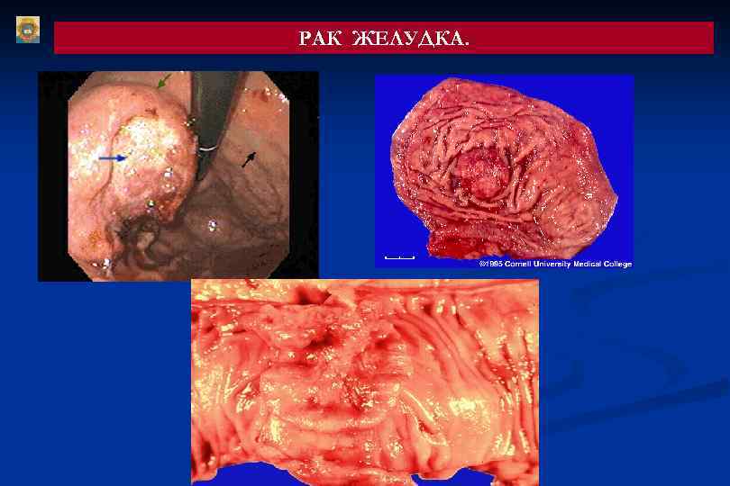 РАК ЖЕЛУДКА. 