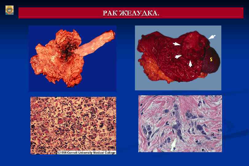 РАК ЖЕЛУДКА. 