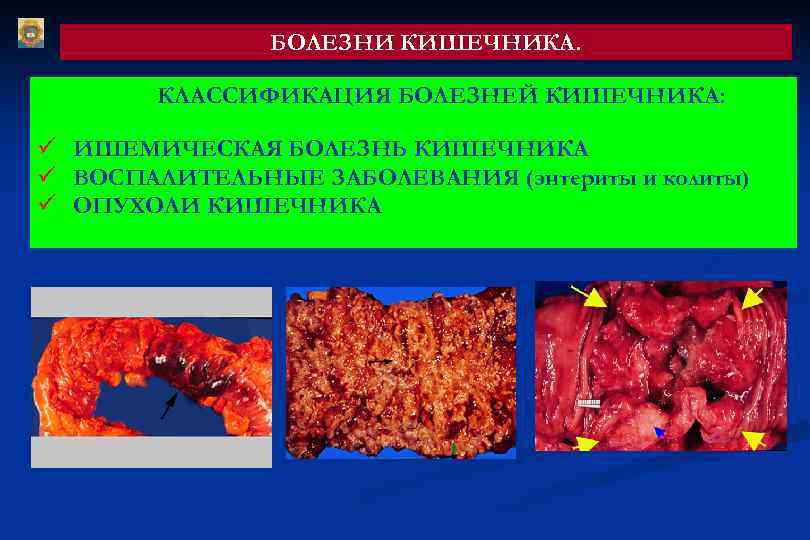 БОЛЕЗНИ КИШЕЧНИКА. КЛАССИФИКАЦИЯ БОЛЕЗНЕЙ КИШЕЧНИКА: ü ИШЕМИЧЕСКАЯ БОЛЕЗНЬ КИШЕЧНИКА ü ВОСПАЛИТЕЛЬНЫЕ ЗАБОЛЕВАНИЯ (энтериты и