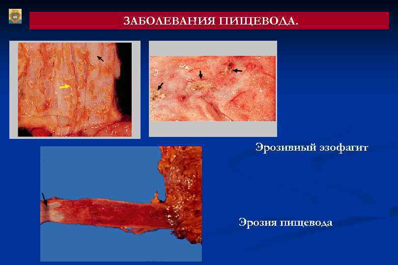 ЗАБОЛЕВАНИЯ ПИЩЕВОДА. Эрозивный эзофагит Эрозия пищевода 
