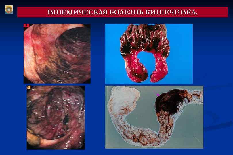 ИШЕМИЧЕСКАЯ БОЛЕЗНЬ КИШЕЧНИКА. 