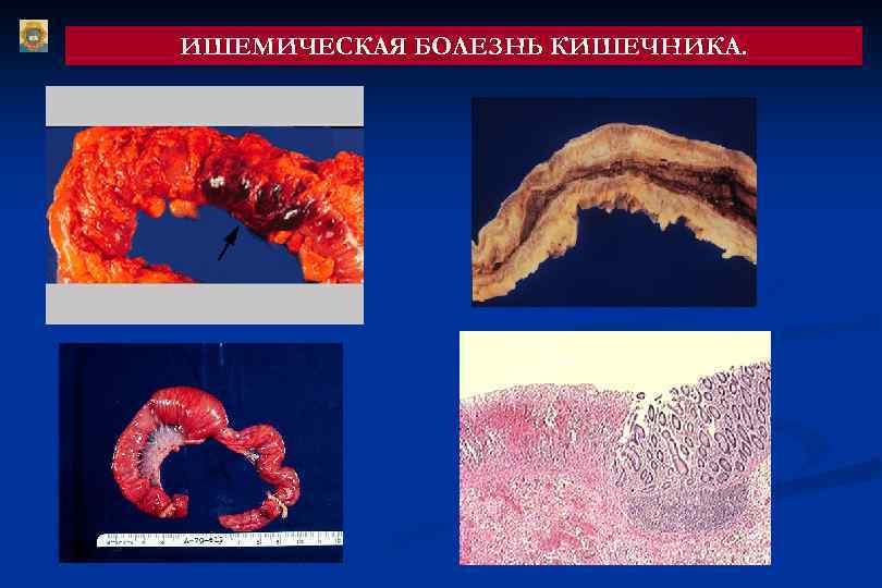 ИШЕМИЧЕСКАЯ БОЛЕЗНЬ КИШЕЧНИКА. 