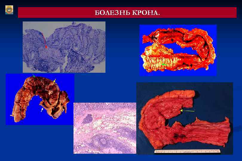 БОЛЕЗНЬ КРОНА. 