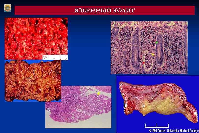 ЯЗВЕННЫЙ КОЛИТ 