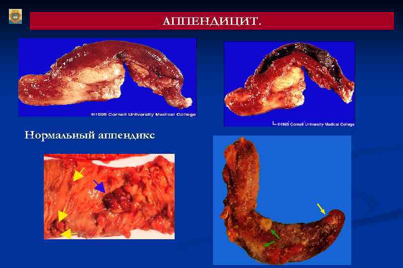 АППЕНДИЦИТ. Нормальный аппендикс 