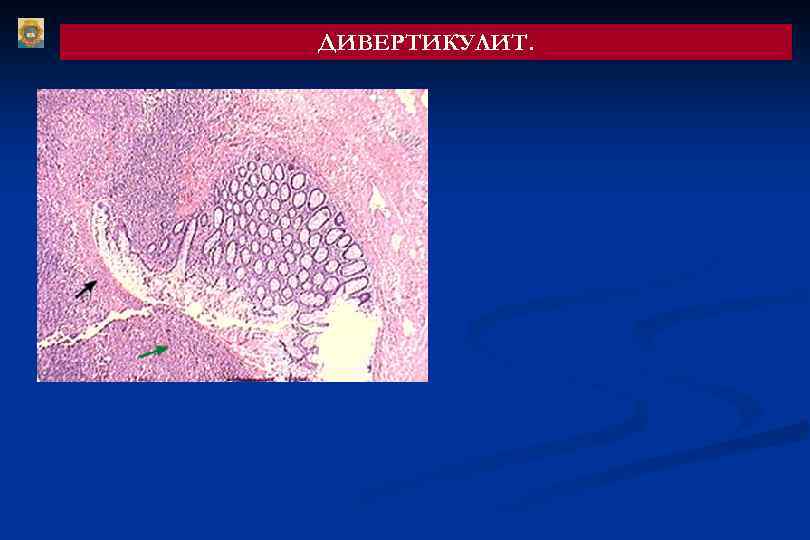 ДИВЕРТИКУЛИТ. 