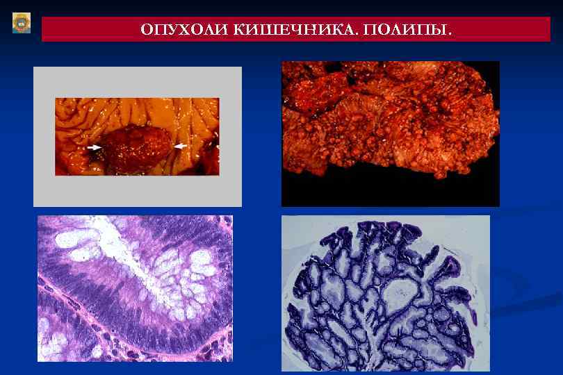 ОПУХОЛИ КИШЕЧНИКА. ПОЛИПЫ. 