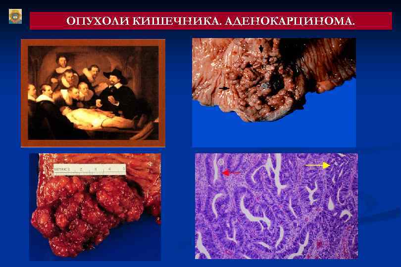 ОПУХОЛИ КИШЕЧНИКА. АДЕНОКАРЦИНОМА. 