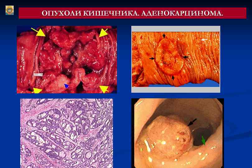 ОПУХОЛИ КИШЕЧНИКА. АДЕНОКАРЦИНОМА. 