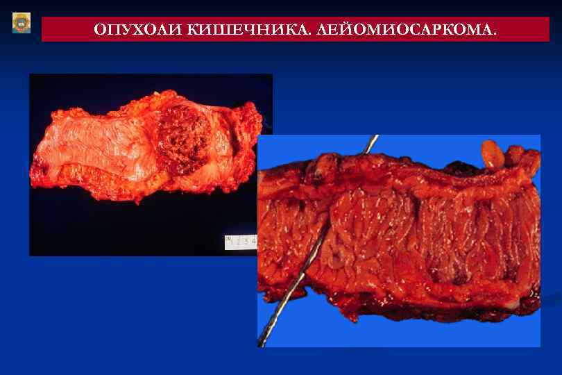 ОПУХОЛИ КИШЕЧНИКА. ЛЕЙОМИОСАРКОМА. 