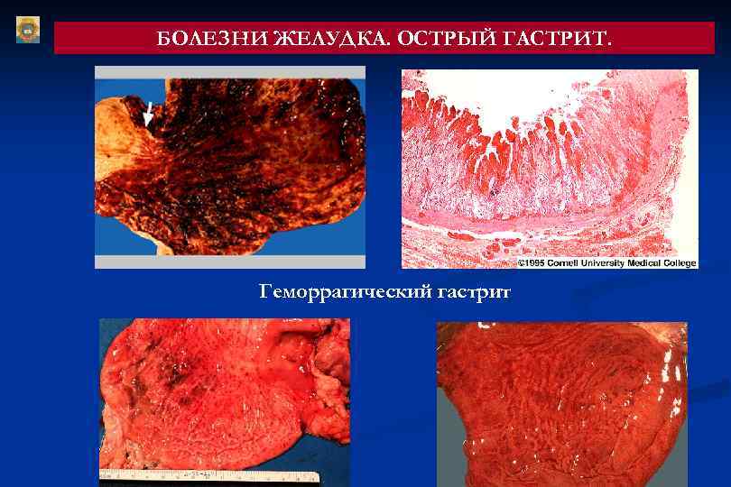 БОЛЕЗНИ ЖЕЛУДКА. ОСТРЫЙ ГАСТРИТ. Геморрагический гастрит 